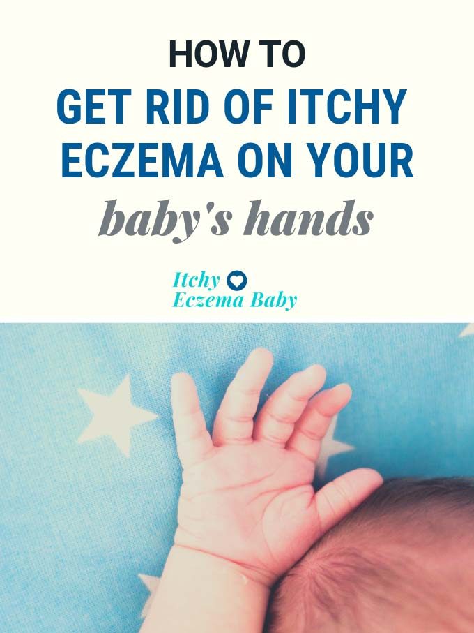 Treatment for Eczema on Hands - Babies and Toddlers | Itchy Eczema Baby