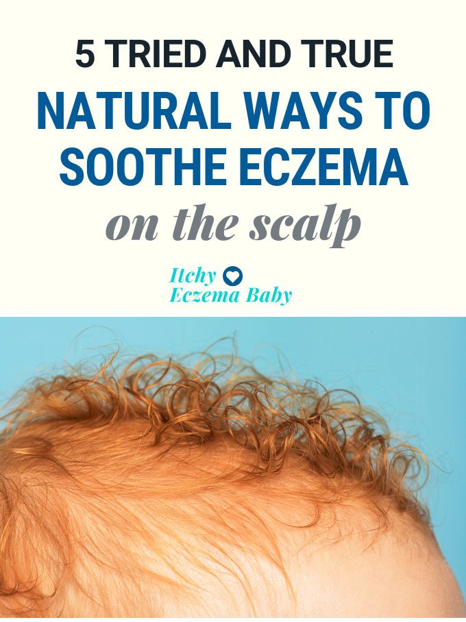 Natural Remedies for Scalp Eczema | Itchy Eczema Baby